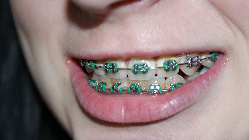  know about braces.