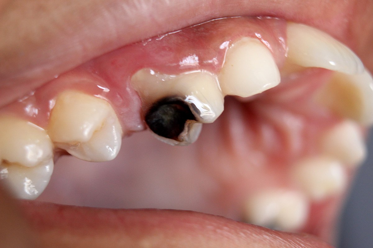 Dental Caries Cavity