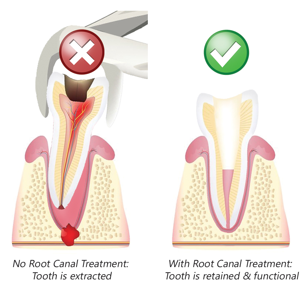 Extraction Vs Root Canal Treatment The Difference Between Them 