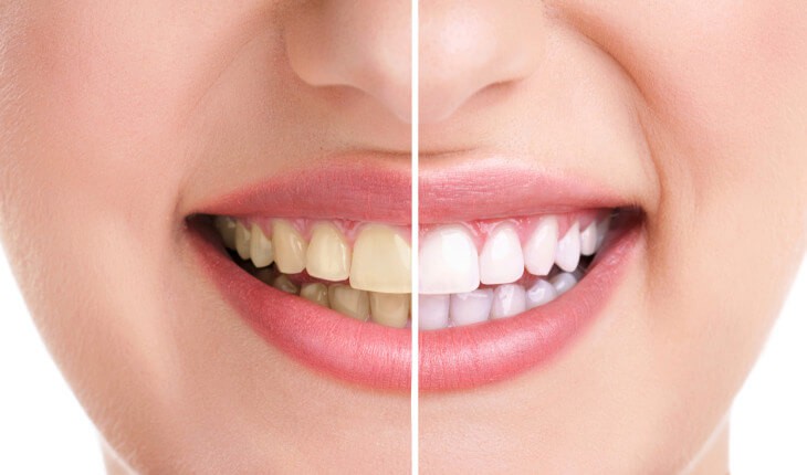 How to get rid of yellow teeth?
