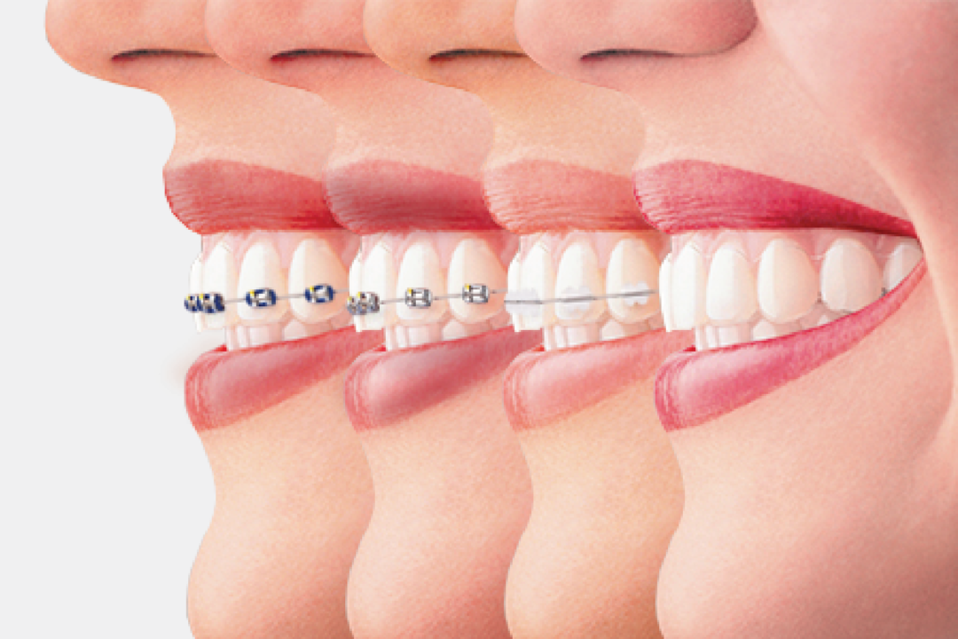 know about braces